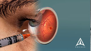 How Macular Degeneration Affects Your Vision  3D animation [upl. by Ariek]