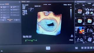 ABLATION for ATRIAL FIBRILLATION Watch a live procedure [upl. by Missak]