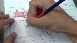 Removable Partial Denture  Reviewing design and how to draw [upl. by Domela784]