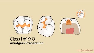 Class I Amalgam Preparation  My Dental Key [upl. by Brunhilde]