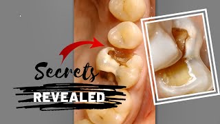 Secrets of Caries Excavation Revealed  Dentistry [upl. by Tommy]