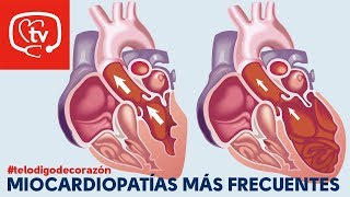 Tipos de miocardiopatías telodigodecorazón [upl. by Lerrej294]