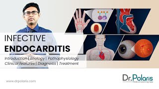 INFECTIVE ENDOCARDITIS  Etiology Pathophysiology Clinical Features Management  Animated [upl. by Froehlich]