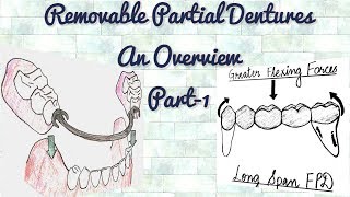 Removable Partial DenturesAn Overview Part1Indications of RPD [upl. by Ag]