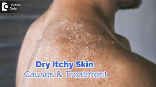 Dry itchy skin all over body Causes Diagnosis Treatment  Dr Rashmi Ravindra  Doctors Circle [upl. by Danuloff]