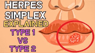 Herpes Simplex  Type 1 vs Type 2  EXPLAINED IN 2 MINUTES [upl. by Alekehs]