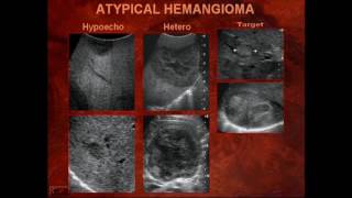 Vascular Birthmarks Hemangiomas and Vascular Malformations [upl. by Enyal700]