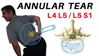 Annular Tear L4L5 L5S1 Disc Bulges [upl. by Limoli]