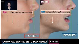 COMO HACER CRECER LA MANDIBULA  ANTES  DESPUES Caso clínico de TWIN BLOCK 8 meses [upl. by Anuahs]