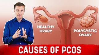 Natural way to treat Polycystic ovarian syndrome PCOSPCOD  Dr Vivek Joshi [upl. by Suhail376]