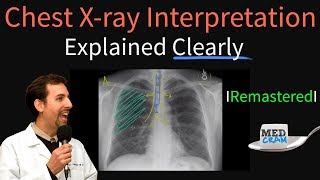 Chest X Ray Interpretation Explained Clearly  How to read a chest Xray [upl. by Sirron]