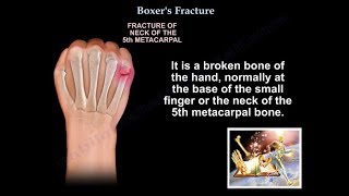 Boxers Fracture  Everything You Need To Know  Dr Nabil Ebraheim [upl. by Frants]