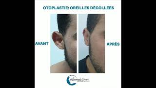 Implants Earfold pour recoller les oreilles  RESULTAT partie 4 [upl. by Dittman]