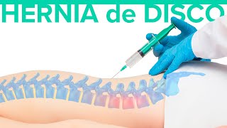 Cuál es el MEJOR TRATAMIENTO para la hernia discal 🦾 Hernia de disco [upl. by Ahsym]