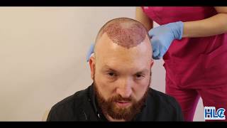 Hair Transplant Turkey  BBC Documentary  Paul Before amp After [upl. by Imas434]