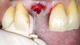 Atraumatic Root Extraction by means of an endodontic file  Dr Fabio Cozzolino [upl. by Johppah]