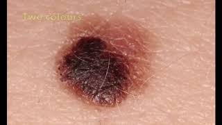 Holy Moley Episode 1 Could it be Melanoma Intro to skin cancer diagnosis for medical students [upl. by Brigette]