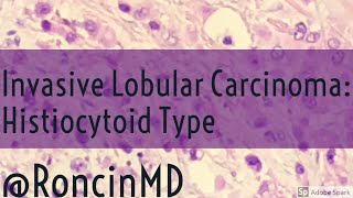 Ductal carcinoma in situ DCIS and Paget Disease  Histopathology [upl. by Hendrix]