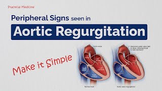 Making Bedside Diagnosis Easy Peripheral Signs in Aortic Regurgitation [upl. by Andrus]