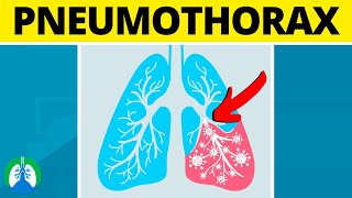 Pneumothorax Medical Definition  Quick Explainer Video [upl. by Trenna]