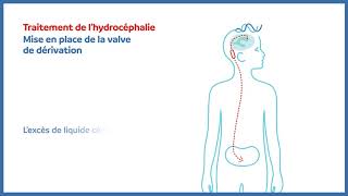 Hydrocéphalie  valve de dérivation peritonéale [upl. by Kellia]