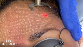 Minimize Acne Scarring With Laser Resurfacing [upl. by Ozzy52]