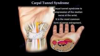 Carpal Tunnel Syndrome  Everything You Need To Know  Dr Nabil Ebraheim [upl. by Ferdinanda]