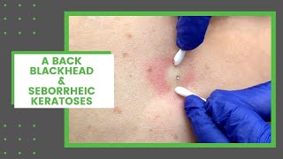 A Back Blackhead amp Seborrheic Keratoses  Dr Derm [upl. by Ahsha322]