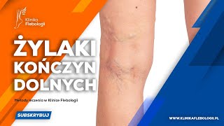 Żylaki kończyn dolnych  metody leczenia [upl. by Aineval38]