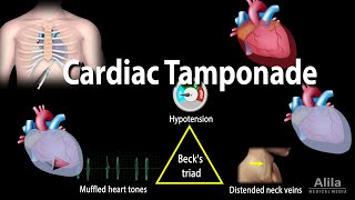 Cardiac Tamponade Pathophysiology Etiology Symptoms Diagnosis and Management Animation [upl. by Caldwell488]