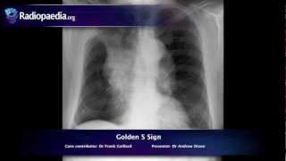 Golden S sign  radiology video tutorial xray [upl. by Ysied272]