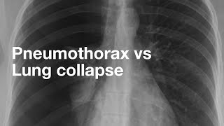 Pneumothorax vs Lung Collapse [upl. by Murrell]