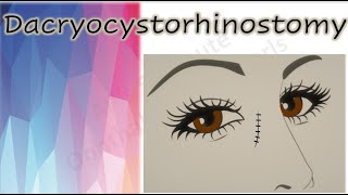 Dacryocystorhinostomy  DCR [upl. by O'Donovan972]