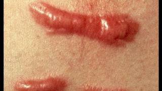 DermTV  How to Treat a Keloid Scar DermTVcom Epi 279 [upl. by Alrick]