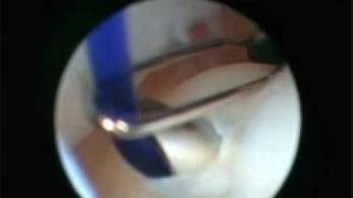 arthroscopic TFCC repair [upl. by Harrad]