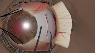 Strabismus surgery Recession [upl. by Sussi]