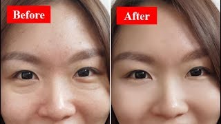 How To Get Rid Of Your Eye Bags Fast amp Naturally At Home [upl. by Anade816]