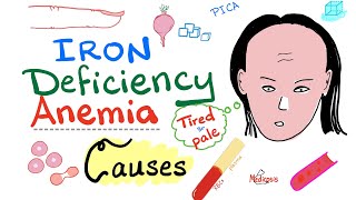 Iron Deficiency Anemia  Causes  Hematology Series [upl. by Launce155]