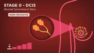 Management and Treatment of Ductal Carcinoma in Situ DCIS [upl. by Aecila]