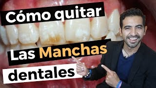 Así elimino las manchas en los dientes CASO DE ÉXITO [upl. by Alahcim]