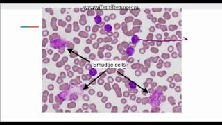 Chronic Lymphocytic Leukemia CLL [upl. by Oj]