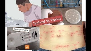 Typhoid vs typhus fever [upl. by Ireg449]