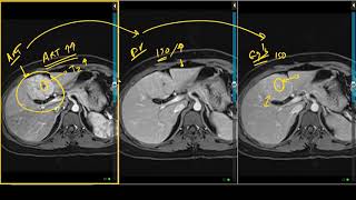 Liver Hemangioma  Do hemangiomas affect liver function  247nht [upl. by Llywellyn]