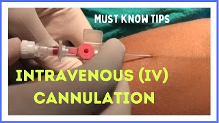 INTRAVENOUS IV CANNULATION in 5 mins How to insert [upl. by Ahsieat]