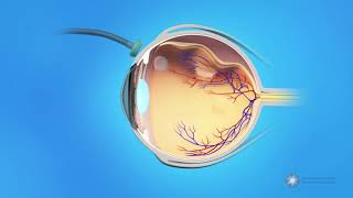 Vitrectomy Surgery for Detached Retina [upl. by Yeuh]