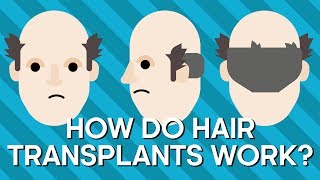 5 Mistakes in a freshly transplanted Hairline [upl. by Biamonte]