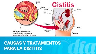 Causas y tratamientos para la cistitis [upl. by Aleacem531]